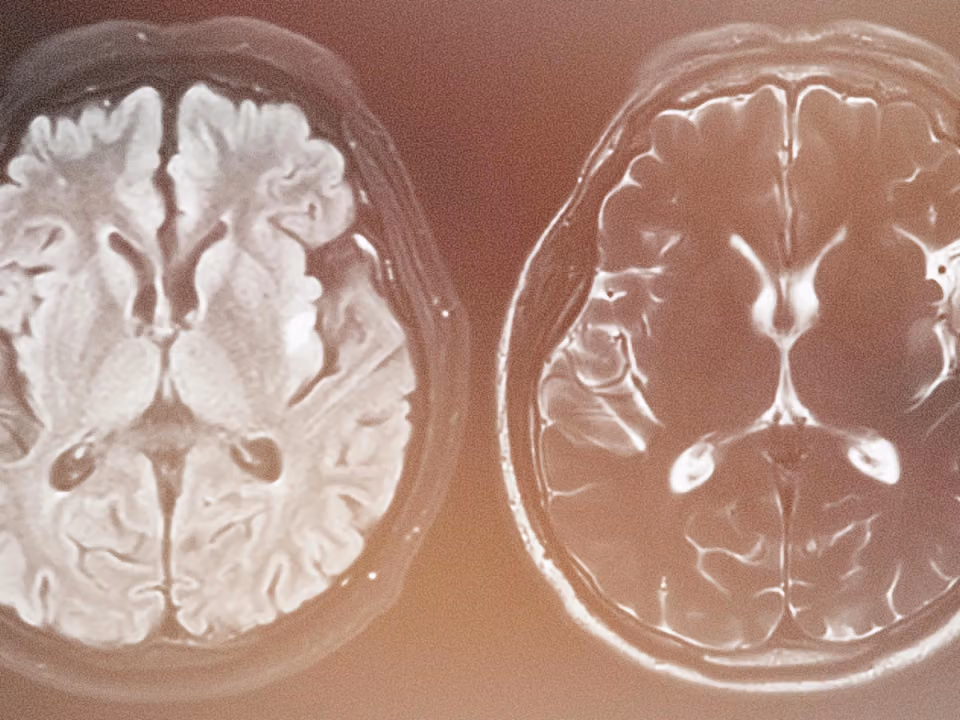 Two side-by-side axial brain MRI scans with a warm brown-orange tint and grainy texture. The left scan shows bright white tissue, and the right shows darker tissue with bright white fluid-filled spaces.