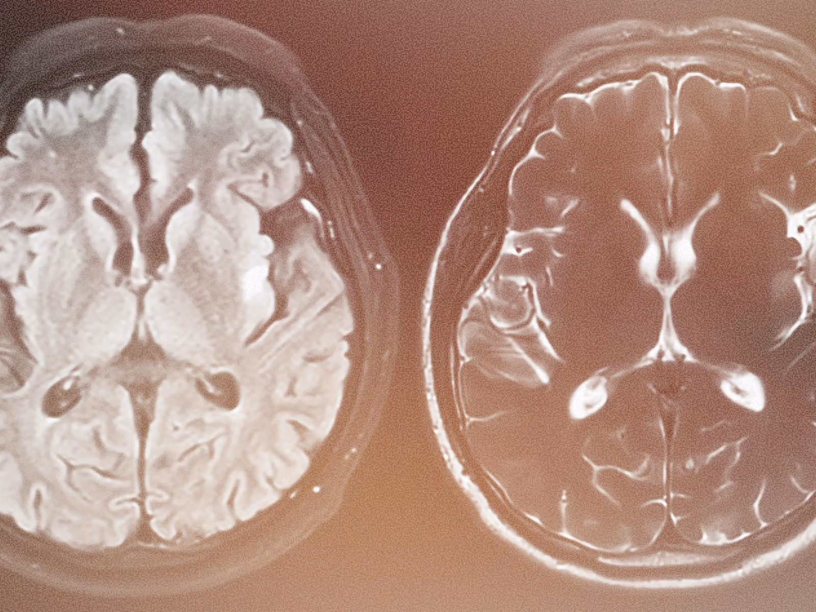 Two side-by-side axial brain MRI scans with a warm brown-orange tint and grainy texture. The left scan shows bright white tissue, and the right shows darker tissue with bright white fluid-filled spaces.