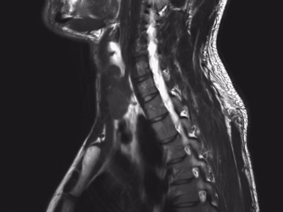 Placeholder — replace with MRI with Spine article hero image