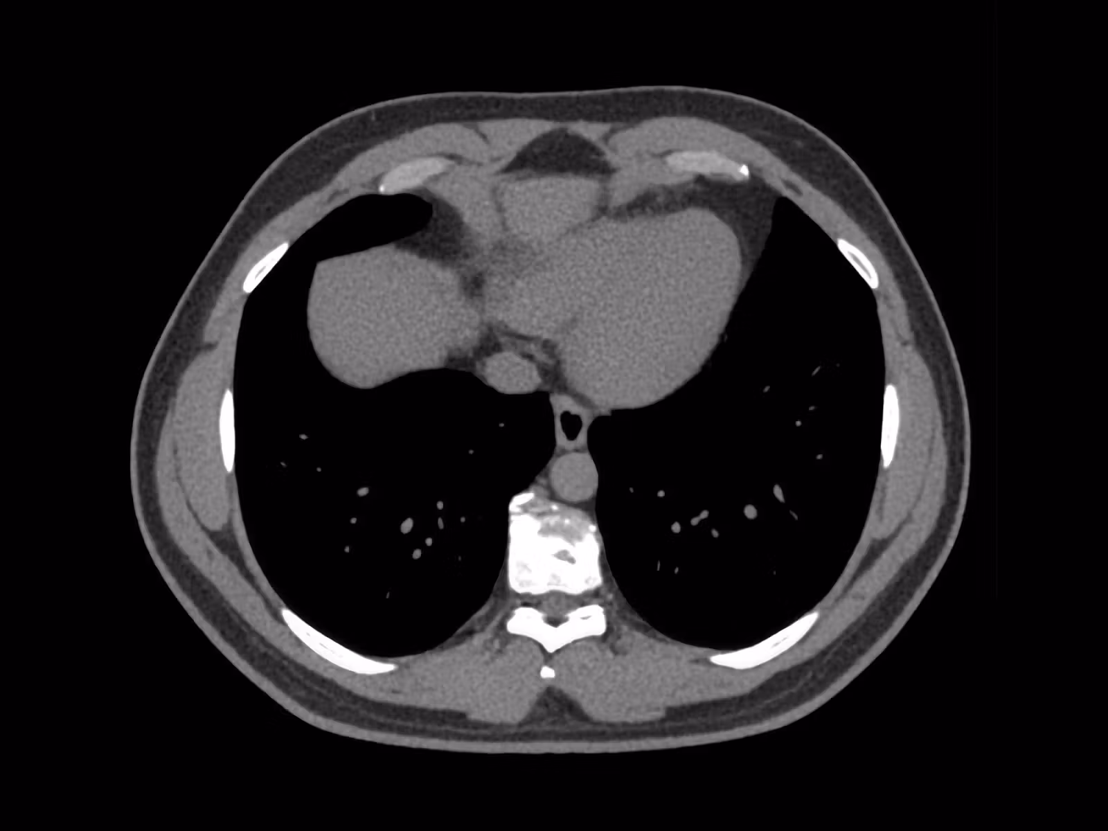 Low-dose lung CT screening
